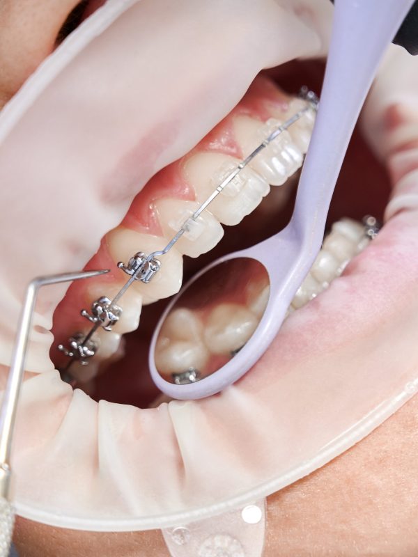 Close up of orthodontist using cofferdam and dental instruments while placing orthodontic brackets on patient teeth. Concept of stomatology, dentistry and orthodontic treatment.